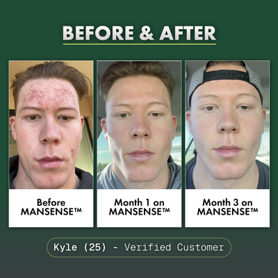MANSENSE BioBalance+ Acne Treatment