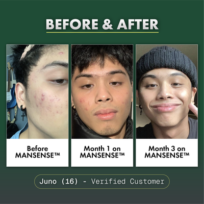 MANSENSE BioBalance+ Acne Treatment