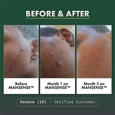 MANSENSE BioBalance+ Acne Treatment