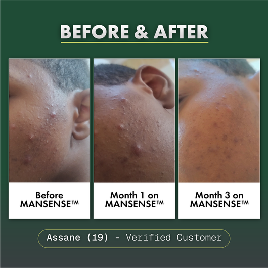 MANSENSE BioBalance+ Acne Treatment