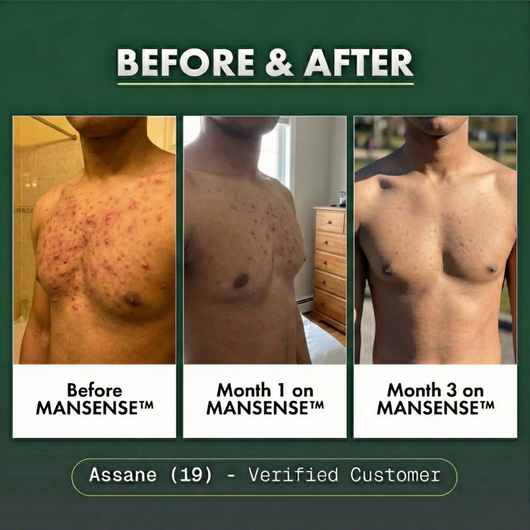 MANSENSE BioBalance+ Full Body Acne Treatment
