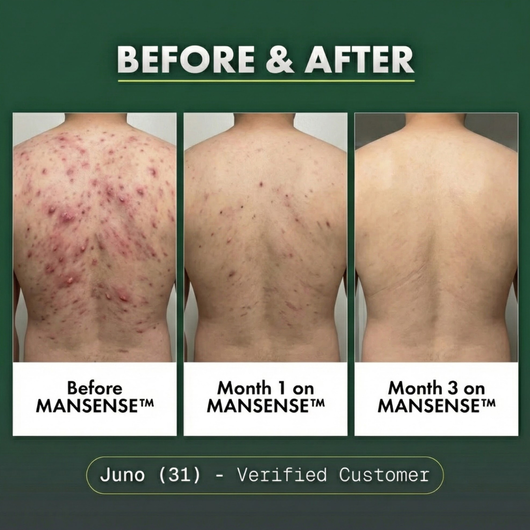 MANSENSE BioBalance+ Full Body Acne Treatment